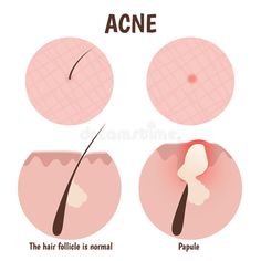 Structure of the hair follicle royalty free illustration Beauty Job, Korean 10 Step Skin Care, Fresh Aloe Vera Gel, Beauty Mistakes, Skin Care Specialist, Problem Skin, Facial Steaming, Facial Skin Care Routine, Instagram Ideas Photography