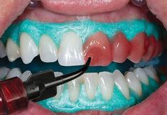 Bleaching Techniques, Teeth Aligners, White Teeth Tips, Tooth Bleaching, Teeth Tips, Laser Whitening, Dental Bleaching, Rotten Teeth, Dental Photos