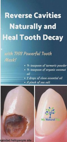 #Dental #for #HealthyLiving #Secrets #Radiant #Unlocking #Smile #Care #Tips #HealthTips #FitLife #NutritionTips #a #HealthyLifestyle #FitnessTips Reverse Cavities Naturally, Cavity Remedy, Baking Soda Teeth, Reverse Cavities, Tooth Ache Relief, Tooth Cavity, Tooth Decay Remedies, Homemade Toothpaste, Heal Cavities