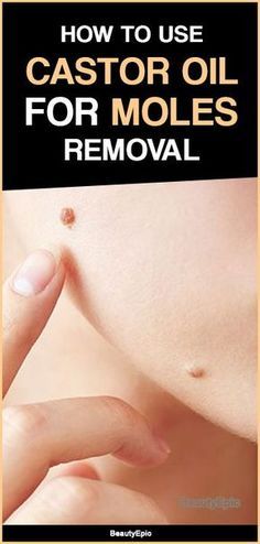 Cancerous Moles, Red Moles, Natural Health Remedies