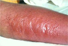 Erysipelas – Causes, Symptoms, Treatment Skin Diseases, The Skin, Hot Dog Buns, One Day, Disease, Ethnic Recipes, Skin, Health