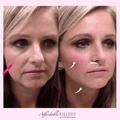 Affordable Fillers of Chattanooga - BOTOX & Dermal Fillers Facial Injections, Cosmetic Fillers, Face Fillers, Wrinkle Filler, Anti Wrinkle Treatments, Dark Circles Under Eyes, Dermal Fillers