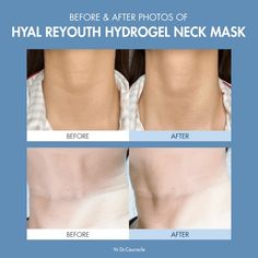 Designed to provide multi-functional neck care, the DR CEURACLE Hyal Reyouth Hydrogel Neck Mask lifts, brightens, and hydrates the skin, aiding in the improvement of neck wrinkles and hyperpigmentation. The hydrogel mask is infused with a moisturising ampoule that boasts 10 types of Hyaluronic Acid to boost skin moisture levels, providing a plumped appearance, while preventing moisture loss. The formula also contains Fructan, Collagen Extract, and Adenosine to deliver long-lasting hydration and enhance skin elasticity. With high adhesion, the flexible mask is water-soluble and melts at the skin temperature, nourishing the skin without irritation. After all the active ingredients are absorbed, the sheet becomes thin. The product has undergone clinical testing, and it is suitable for all ski Hydrogel Mask, Dr Ceuracle, Neck Mask, Neck Wrinkles, Fragrance Ingredients, Skin Elasticity, Hydrate Skin, Skin Moisturizer, Active Ingredient