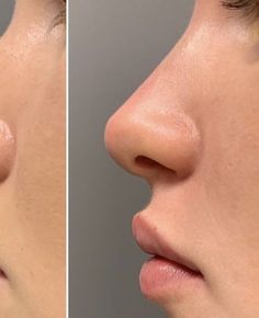 Defined Nose Bridge, Nose Job Natural, Up Turned Nose, Perfect Nose Front View, Nose Job Inspo, Noses Reference, Natural Nose Job, Nose Inspiration