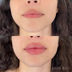 Lip Filler Technique, Chin Filler, Botox And Filler, Lip Lift, Lips Inspiration, Danielle Smith, Botox Lips, Facial Fillers, Facial Contouring