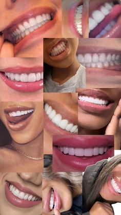 #teeth #pinterest Teeth Goals, Cute Braces Colors, Braces Tips, Getting Braces, Cute Braces, Veneers Teeth, Manifesting Vision Board