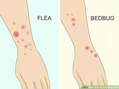 how to get rid from bedbugs on your feet step by step guide for