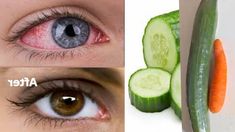 Cucumber For Eyes, Whiting Skin, Eye Whitening, Eye Health Remedies, Brighten Eyes, Bad Eyesight, Improve Vision, Eye Vision, Natural Remedies For Migraines