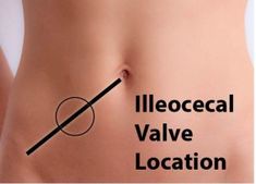 For our current population of patients we discuss the ileocecal valve with every single new patient and over 90% of existing patients.  It is just that important. The last portion of your small intestine, called the ileum, joins the first portion of your large intestine, called the cecum.  Between these two sections of the bowel … Fibro Symptoms, Ileocecal Valve, Small Intestine Bacterial Overgrowth, Self Massage, Natural Therapy, Acid Reflux, Alternative Health