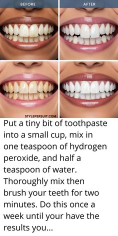 Image showing whiten teeth before and after with instructions using ingredients like baking soda and lemon, coconut oil, hydrogen peroxide and water Teeth Care Routine, Perfect White Teeth, White Teeth Tips, Lemon Baking, Make Teeth Whiter, Teeth Tips