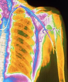 an x - ray image of the chest shows what appears to be a ribcage