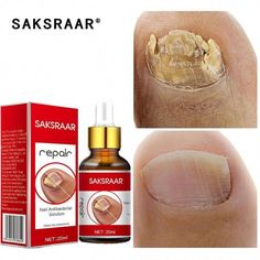 Click Here To Read More: | Nail Foot, Fungal Nail, Essential Oil Storage, Ingrown Toe Nail, Toenail Fungus, Fungal Infection, Nail Fungus, Homemade Remedies, Cuticle Oil Nail Foot, Essential Oil Storage, Oil Storage, Homemade Remedies