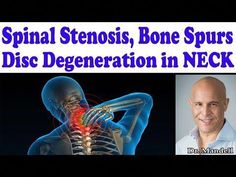 I will share great strategies to help combat cervical spinal stenosis, bone spurs, and disc degeneration. 13 Best Postural Exercises for Forward Head Posture... Cervical Disc Degeneration, Cervical Stenosis Exercises, Cervical Exercise, Spinal Stretches, Spinal Degeneration