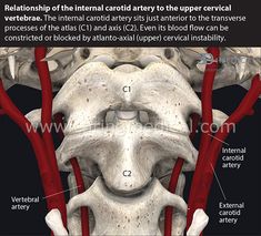 The internal carotid artery supplies blood to the brain. Where it sits in front of of the transverse processes of the C1 (atlas) and C2 (axis) makes it vulnerable to compression by cervical spine instability if the C1 and C2 are unstable. Cervical Instability, Internal Carotid Artery, Spine Problems, Vertebral Artery, Cervical Pain, Cervical Spondylosis, Carotid Artery, Pinched Nerve, Cervical Spine