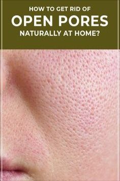 Open Pores, Natural Skin Care Remedies, Natural Face Skin Care, Good Skin Tips, Glow Skin, Facial Skin Care Routine, Skin Care Remedies, Skin Care Solutions, Skin Care Recipes