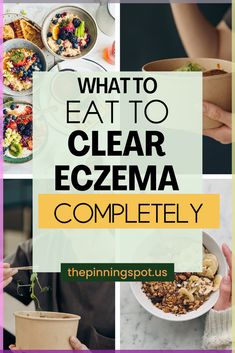 Unveil the secrets to a skin free from eczema with this eczema diet guide I used to heal my eczema. Discover the power of the skin foods in getting rid of eczema, understand the benefits of a skin diet and learn about the best eczema diet to eat. Equip yourself with knowledge on natural eczema treatments and start your journey to heal eczema from the inside out. This guide provides essential insights into the foods you should include and those you should avoid for better skin health. Meals For Skin Health, Foods To Avoid For Excema, Natural Remedy For Excema, Excema Treatments Diy, Excema Diet For Kids, Excema On Face Skincare, Natural Remedies For Excema, How To Get Rid Of Excema, Excema Diet