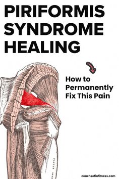 A step-by-step guide to heal from piriformis syndrome quickly and naturally. Find and fix the root cause of the pain and get long-term relief Piriformis Syndrome Exercises, I Healed, Piriformis Muscle, Piriformis Stretch, Sciatica Exercises, Piriformis Syndrome, Plyometric Workout, Human Anatomy And Physiology, Hip Pain