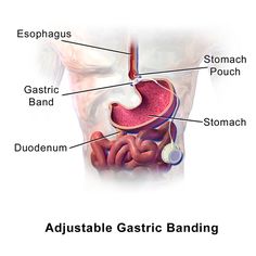 A #laparoscopic adjustable gastric band, commonly called a Lap-Band, A Band, or LAGB, is an inflatable silicone device placed around the top portion of the stomach to treat obesity, intended to slow consumption of food and thus the amount of food consumed. Gastric Band, Weight Problems, Weight Reduction