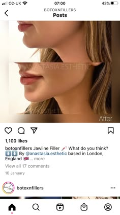 Sliding Genioplasty Before And After, Jaw Line Fillers Before And After, Facial Contouring Fillers, Face Fillers Before And After, Face Contouring Fillers, Jaw Filler Before And After, Botox Jawline Before And After, Fillers Before And After