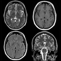 four mri images show different areas of the brain