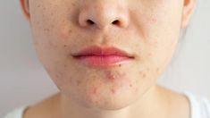 Acne - Yahoo Image Search Results Pimple Free Skin, Pimples On Face, Home Remedies For Acne, How To Get Rid Of Pimples, Skin Specialist