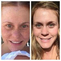 Reverse Products Rodan And Fields Reverse, Dermatologist Recommended Skincare, Dry Skin On Face, Dermatologist Recommended, Sun Damage, 7 Months, Rodan And Fields