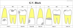 G. V. Black’s classification put carious lesions into 5 categories based on the affected tooth surfaces. Class I: Caries affecting pits and fissures. Class II: Caries affecting interproximal areas of posterior teeth. Class III: Caries affecting interproximal areas of anterior teeth. Class IV: Caries affecting the interproximal areas of anterior teeth that also incorporate the incisal tip/edge. Class V: Caries affecting cervical smooth surfaces. Greene Vardiman Black (1836–1915), commonly known a Registered Dental Hygienist, Dental Assisting, Dental Restoration