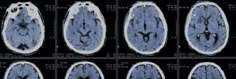 multiple mri images showing different areas of the brain