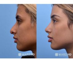 Nose Plastic Surgery, Nose Surgery Rhinoplasty, Nose Fillers, Upturned Nose, Bulbous Nose, Plastic Surgery Fail, Nose Jobs, Rhinoplasty Nose Jobs, Rhinoplasty Before And After