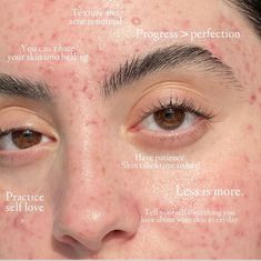 Quotes About Acne Positivity, Acne Self Love, Embracing Acne, Acne Confidence, Acne Pretty, Skin Advice