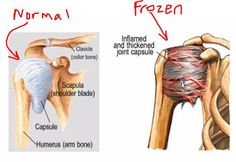 So the bone and joint doc says I have a "frozen shoulder"... yep That Hurts! Arthroscopic Shoulder Surgery, Punkty Spustowe, Survival Medicine, Shoulder Anatomy, Shoulder Problem, Arm Bones, Rotator Cuff Tear, Physical Therapy Assistant