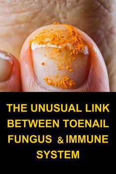 Natural care against fungus might include using baking soda as a foot soak to help neutralize the environment where fungus thrives. #ToenailFungus #NaturalRemedies #NailCare Ugly Toenails, Vapo Rub, Natural Antifungal, Antifungal Cream, Liver Failure, Foot Soak, Toenail Fungus, Nail Fungus, Natural Care