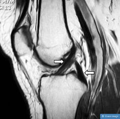 PCL Injuries Can Be Successfully Treated Without Surgery - Champion Physical Therapy and Performance Acl Injury, Injury Prevention, Physical Therapy, Surgery, The Knee, Health And Wellness