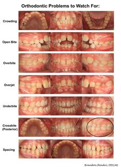 Braces care Anatomy Dental, Braces Care