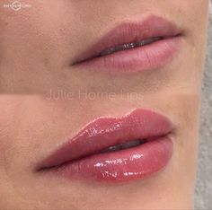 Injector Nurse, Lip Fillers Juvederm, Restylane Lips, Lip Job, Dermal Fillers Lips, Permanente Make-up