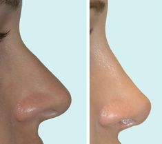 Nose Surgery Rhinoplasty, Rhinoplasty Before And After, Facial Fillers