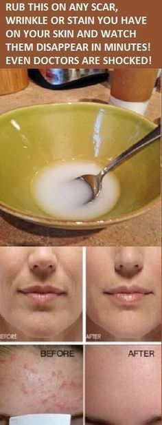 Remove Dark Spots, Homemade Beauty Products, Vaseline