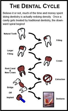 Good Teeth, Tooth Filling, Denture Implants, Dentistry Student, Dental Facts