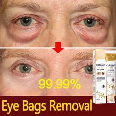 Product updates, new and old products are randomly shipped ������If you need a larger discount. You can click on the image below. Buy 5 get 5 free!!!�� Instant Eye Bag Removal Cream Collagen Removal Wrinkles Firming Skin Fade Fine Lines Anti-Aging Anti Puffiness Dark Circle Brighten Eye Care Korean ▶Effect:Reduces sign Eye Bag Removal, Eye Wrinkle Cream, Firming Skin, Cells Activity, Skin Fade, Eye Brightener, Remove Dark Circles, Face Wrinkles, Face Lines