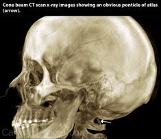 an x - ray image of a human skull shows the area where it is located