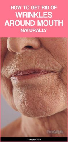 Wrinkles Around Mouth, Wrinkles Remedies Face, Home Remedies For Wrinkles, Sagging Cheeks, Mouth Wrinkles, Get Rid Of Wrinkles, Wrinkle Remedies, Lip Wrinkles, Forehead Wrinkles