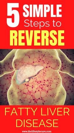 Want to reverse fatty liver disease? Well it's possible! As a medical doctor, chronic diseases make up the majority of cases that doctors see on a regular basis. But what most don't know is that these diseases are lifestyle related, meaning you can change the outcome! Read to know the 6 proven lifes #LiverHealthMatters #HealthyLiverHappyLife #LiverWellness #SupportLiverHealth #LiverDetoxTips #LiverDietIdeas #CleanLiverCleanLife #LiverCareJourney #NourishYourLiver #LiverLovingFoods Liver Diet Plan, Liver Cleanser