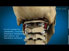 neck pain Cervical Vertigo, Cervical Instability, Neck And Shoulder Exercises, Dysautonomia Pots, Spinal Surgery, Motion Sickness