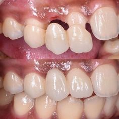 Dental Images, Dental Videos, Dental Photography, Aesthetic Dentistry, Dental Braces, Missing Teeth, Dental Bridge