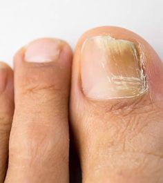 Unghie Malate, Yellow Toe Nails, Nail Remedies, Yellow Nail