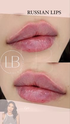 Wide Lips Shape, Round Upper Lip, Heavy Lower Lip Makeup, Lip Filler Shape Ideas Russian, Round Lip Filler, Round Top Lip, Russian Doll Lips, Round Lips Filler, Natural Lip Fillers Before And After