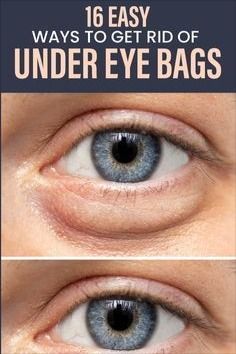 Undereye Bags Remedy, Get Rid Of Eye Bags, Rid Of Eye Bags, Eye Bag Remedies, Puffy Eyes Remedy, Bags Under Eyes, Skin Care Wrinkles, Under Eyes, Dark Circles Under Eyes