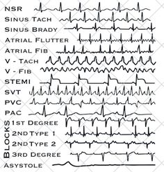 EKG Strips SVG Cardiac Monitor Nurse, Technician, Doctor Gift Digital Download - Etsy Cardiac Technician, Nursing Cardiac, Cardiac Nurse Aesthetic, Cardiac Nurse, Ekg Technician, Gifts For Nursing Students, Cardiac Drips Cheat Sheets, Cardiac Dysrhythmias Cheat Sheets, Cardiac Arrhythmias Nursing