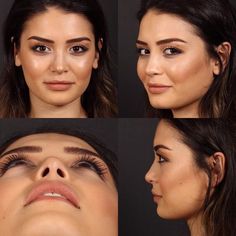 Nose Surgery Rhinoplasty, Plastic Surgery Fail, Nose Types, Face Surgery, Plastic Surgery Gone Wrong