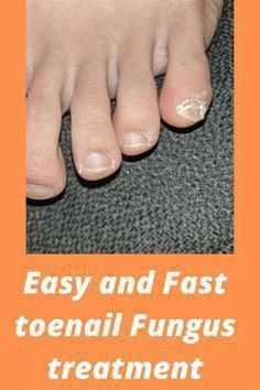 Infected Toenail, Ingrown Toenail, Ingrown Toe Nail